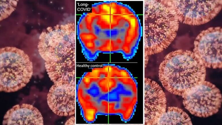 Some Teens' Brains Age Faster During Covid Pandemic: Study –